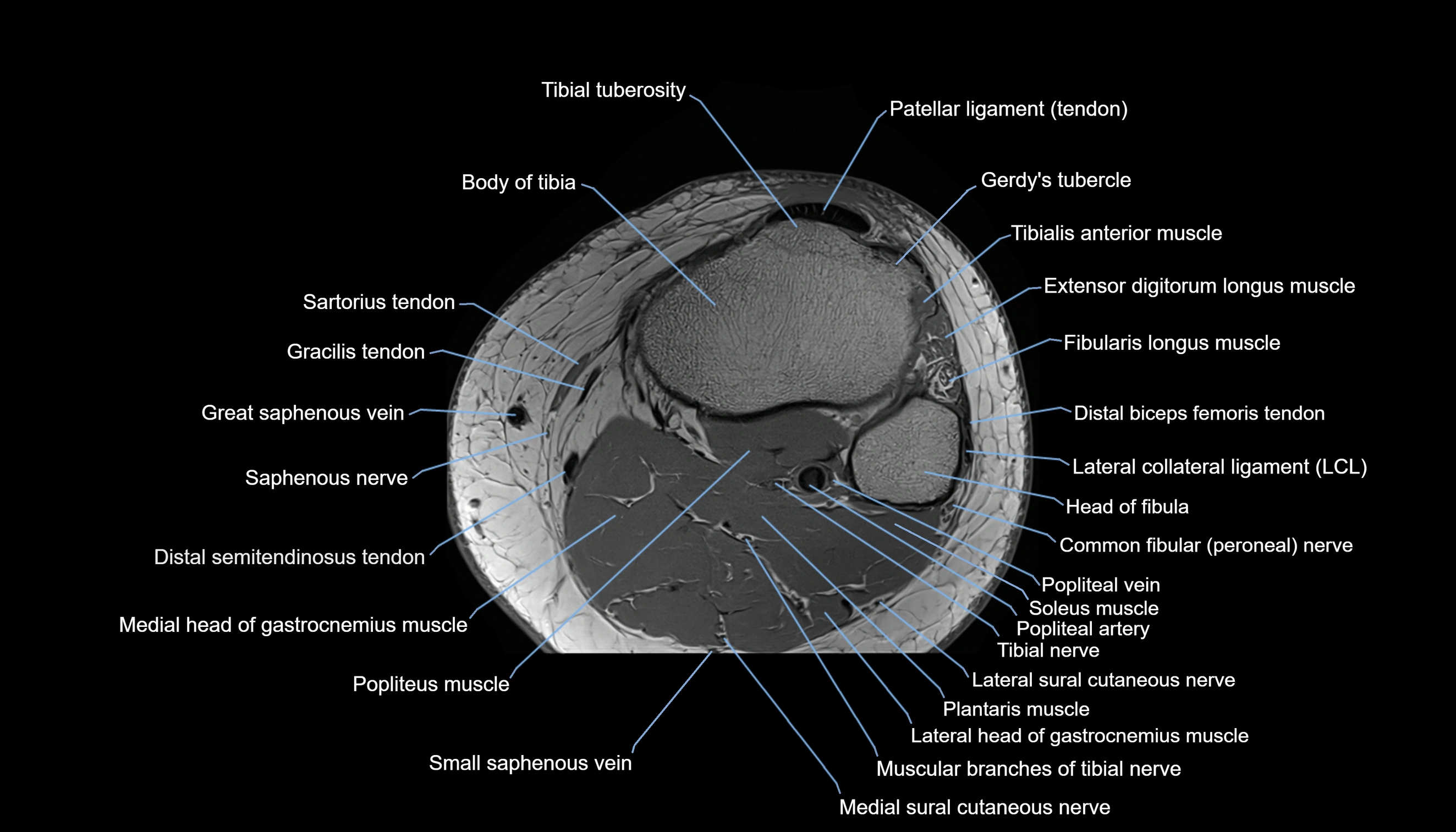 MRI knee  axial cross sectional anatomy 3T radiology  image-img-00001-00042.webp
